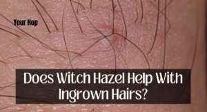 Does Witch Hazel Help With Ingrown Hairs