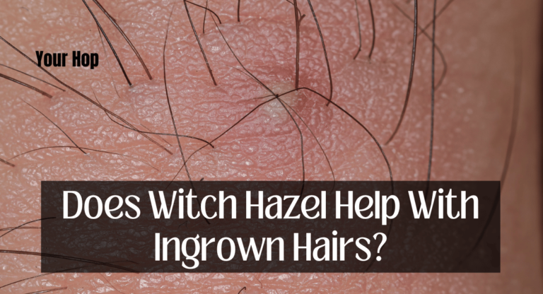 Does Witch Hazel Help With Ingrown Hairs