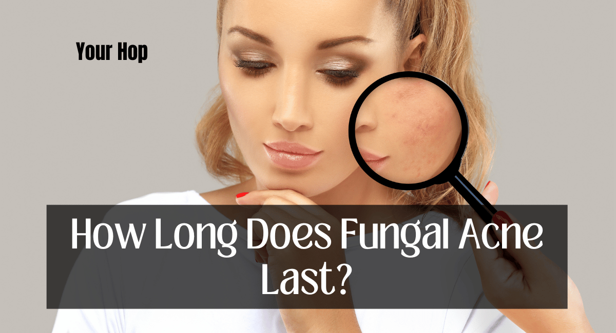 How Long Does Fungal Acne Last