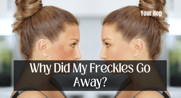 Why Did My Freckles Go Away?